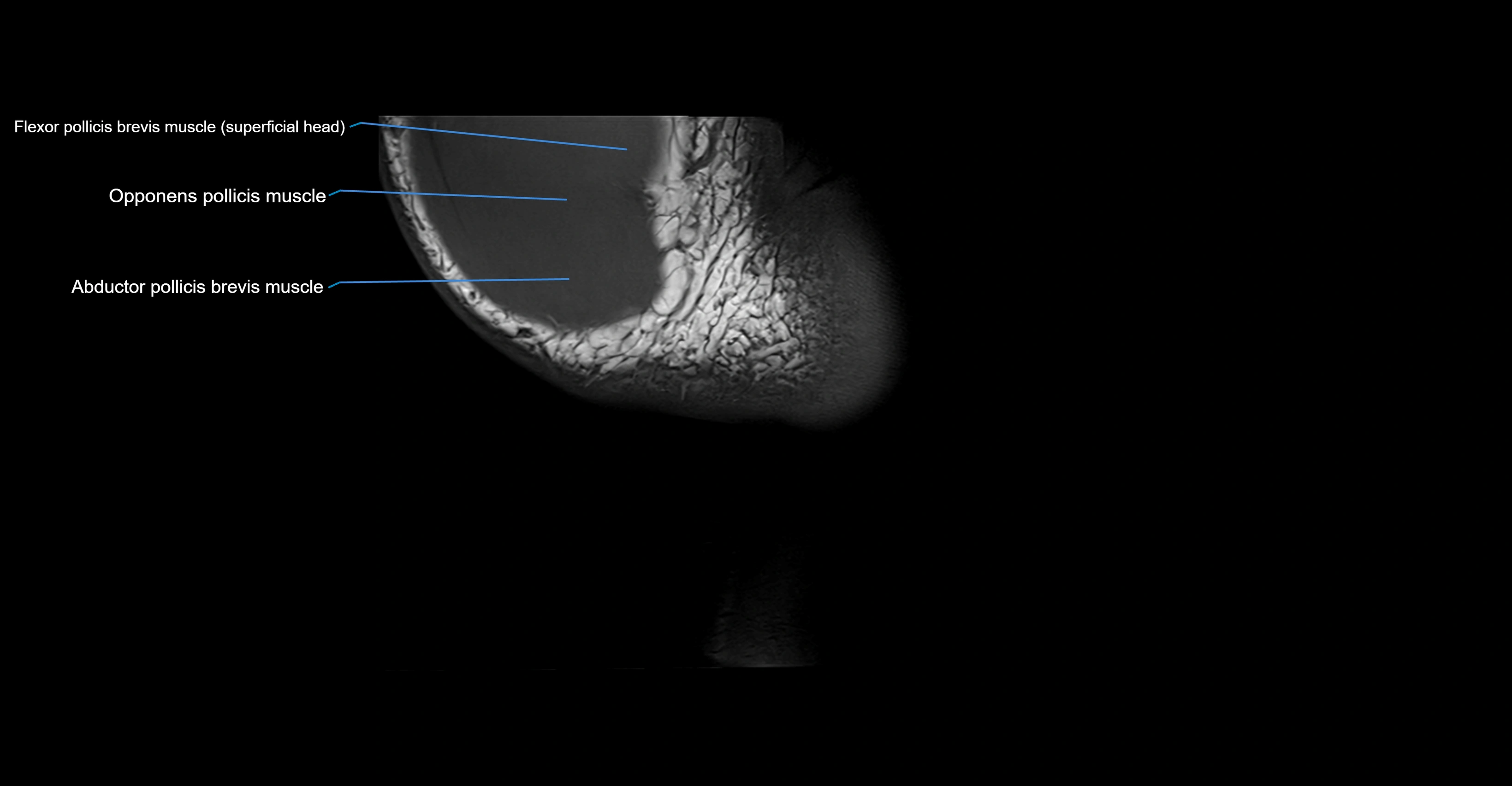 MRI wrist coronal cross sectional anatomy 3T  radiology  image-img-00001-00027.webp